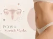 PCOS and stretch marks illustration showing a woman’s abdomen with subtle stretch marks and a uterus graphic